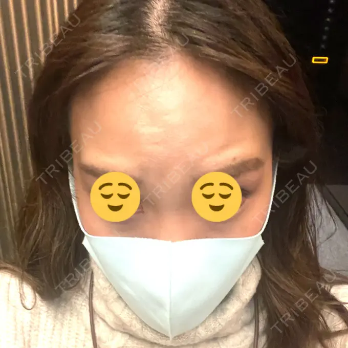 マイクロボトックス / ボトックス（額） / その他（輪郭） ルラ美容クリニック 新宿院 DAY 3 メイン用