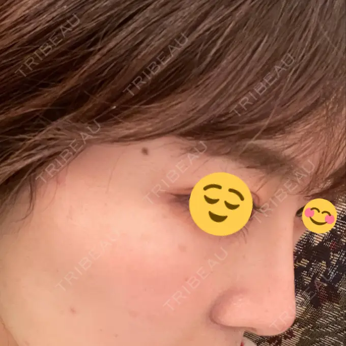 隆鼻術 ヤスミクリニック DAY 32 メイン用