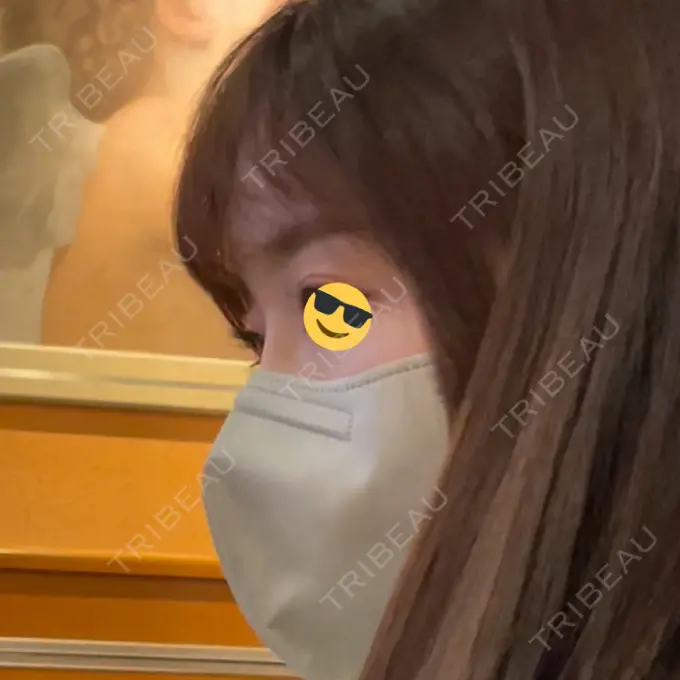 隆鼻術 ヤスミクリニック DAY 32 メイン用