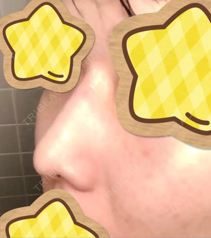 ヒアルロン酸注入（鼻） 恵聖会クリニック 京橋院 DAY 0 メイン用