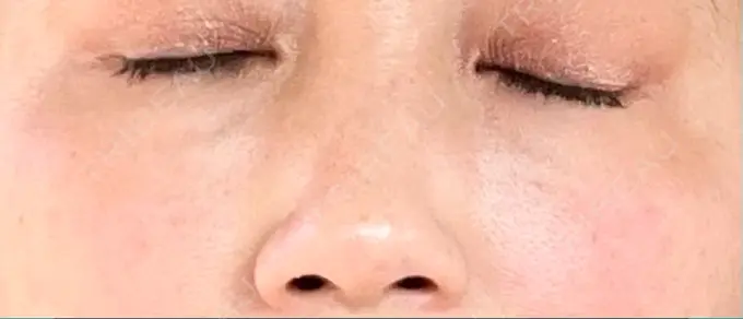 レーザートーニング（美白・肝斑） 銀座美容外科クリニック 銀座院 AFTER メイン用