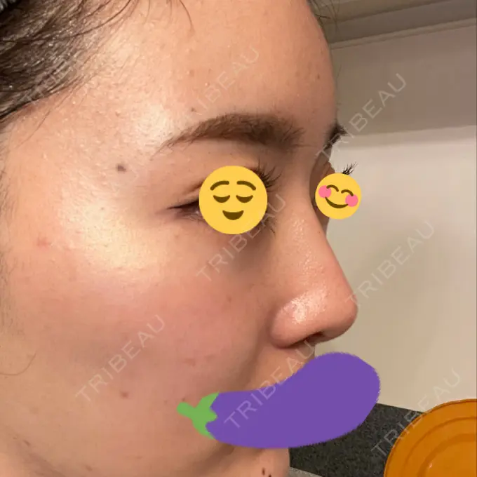 隆鼻術 ヤスミクリニック DAY 35 メイン用