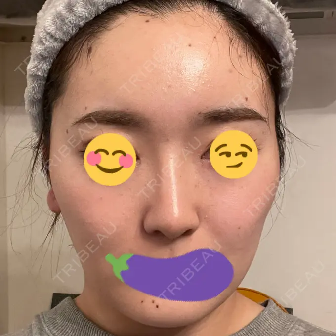 隆鼻術 ヤスミクリニック DAY 35 メイン用