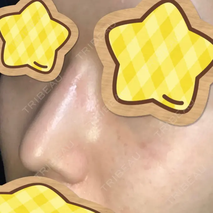 ヒアルロン酸注入（鼻） 恵聖会クリニック 京橋院 DAY 2 メイン用