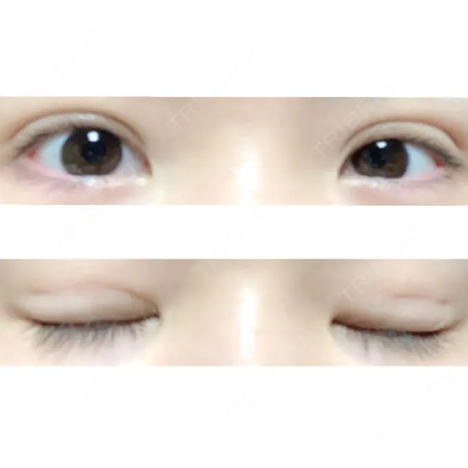 二重埋没 ハナビューティークリニック DAY 22 メイン用