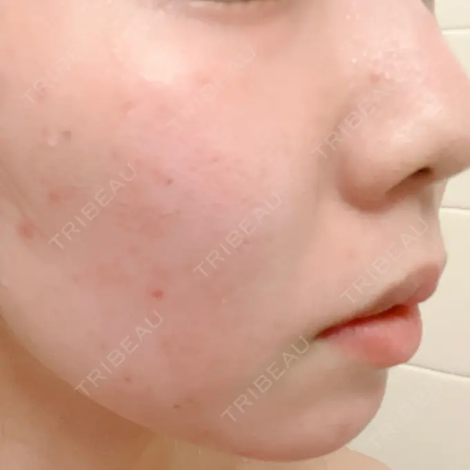 フォトシルクプラス KM新宿クリニック AFTER メイン用