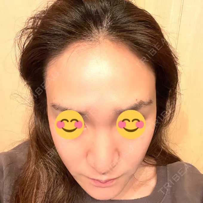 マイクロボトックス / ボトックス（額） / その他（輪郭） ルラ美容クリニック 新宿院 AFTER メイン用