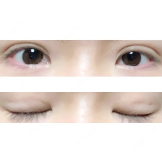 二重埋没 ハナビューティークリニック DAY 23 メイン用