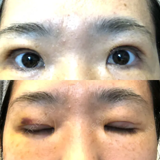 眼瞼下垂（切開） 滋賀美容皮膚科クリニック DAY 7 メイン用