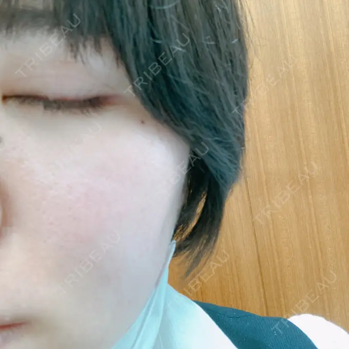 医療脱毛（顔） Jスキンクリニック 【J-SKIN clinic】 AFTER メイン用