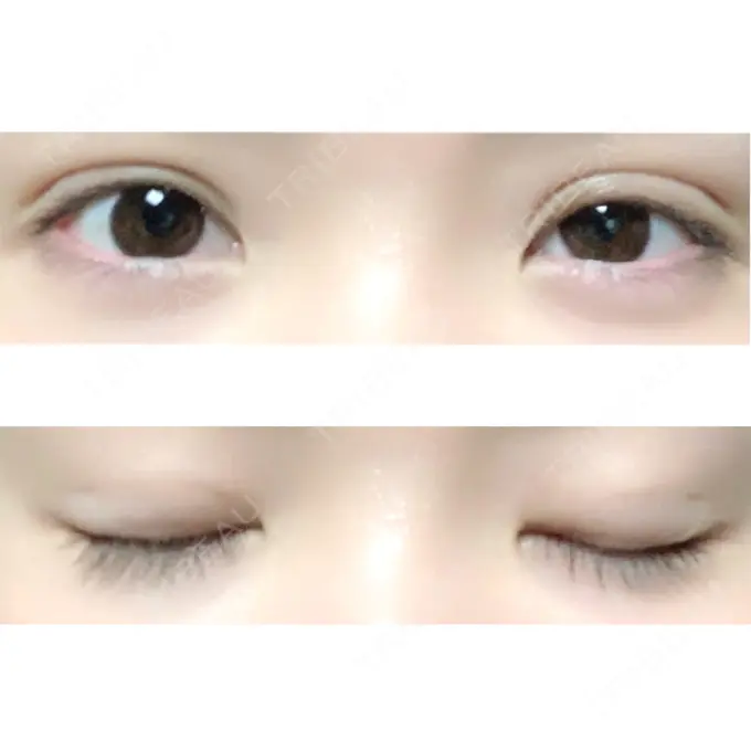 二重埋没 ハナビューティークリニック DAY 25 メイン用