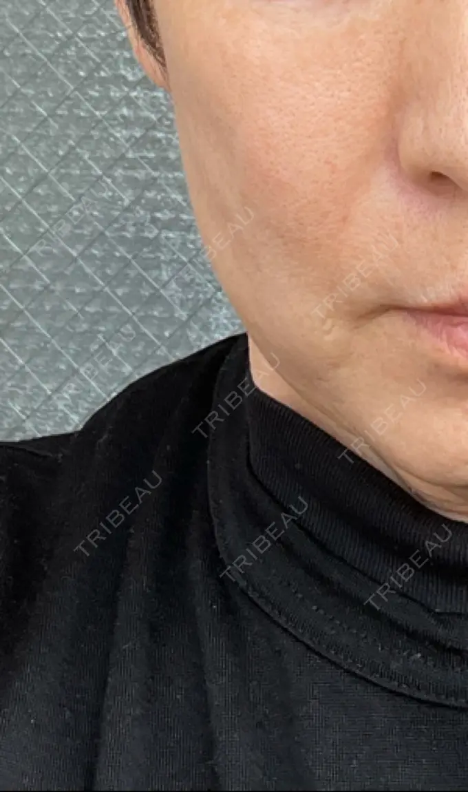 ハイフ（顔） みずほクリニック DAY 24 メイン用