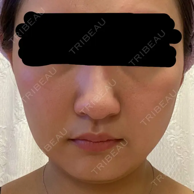 糸リフト / バッカルファット除去 / 脂肪吸引（顔） 東京ミッドクリニック DAY 10 メイン用