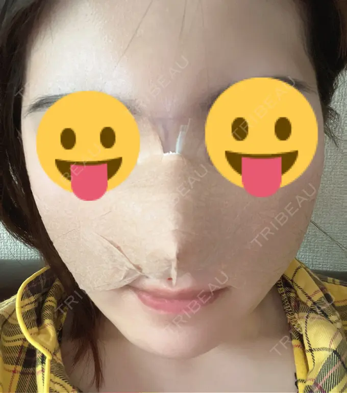 隆鼻術 / 鼻中隔延長（切開） / 鼻修正 / 鼻孔縁下降 / その他（鼻） みずほクリニック DAY 1 メイン用