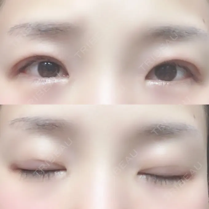 二重埋没 湘南美容クリニック 長野院 DAY 27 メイン用