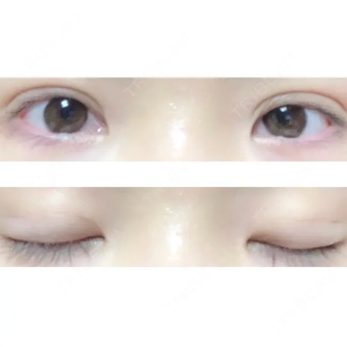 二重埋没 ハナビューティークリニック DAY 27 メイン用