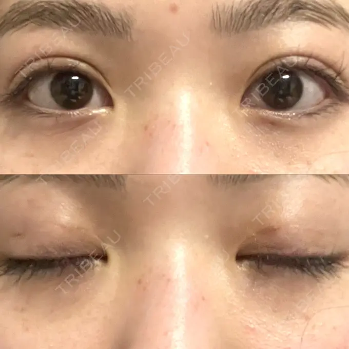 二重埋没 / シワ取りボトックス ルラ美容クリニック 渋谷本院 DAY 15 メイン用