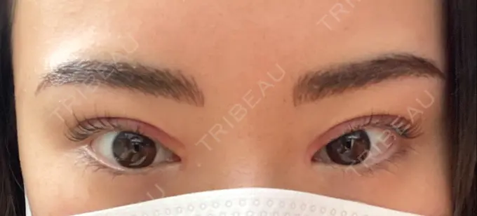 アートメイク（眉） APスキンクリニック銀座 DAY 1 メイン用