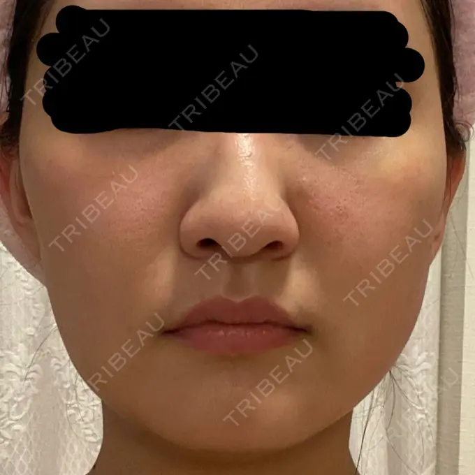 糸リフト / バッカルファット除去 / 脂肪吸引（顔） 東京ミッドクリニック DAY 11 メイン用