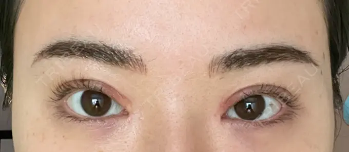 アートメイク（眉） APスキンクリニック銀座 DAY 6 メイン用