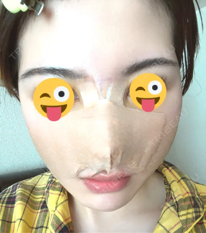 隆鼻術 / 鼻中隔延長（切開） / 鼻修正 / 鼻孔縁下降 / その他（鼻） みずほクリニック DAY 3 メイン用