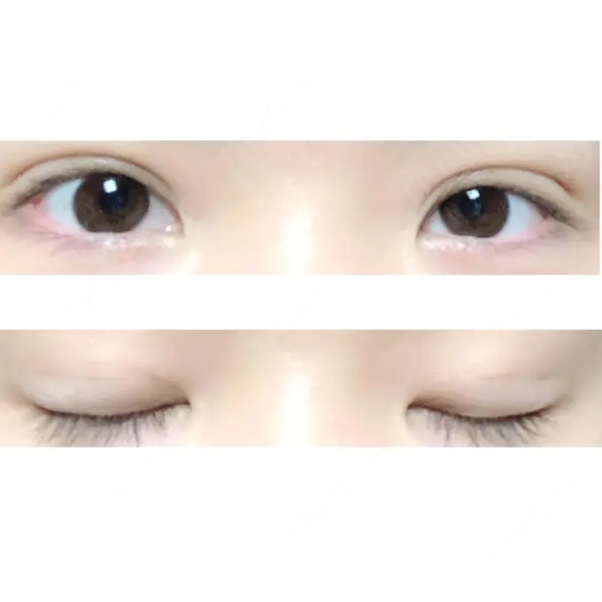 二重埋没 ハナビューティークリニック DAY 29 メイン用