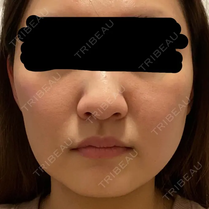 糸リフト / バッカルファット除去 / 脂肪吸引（顔） 東京ミッドクリニック DAY 12 メイン用