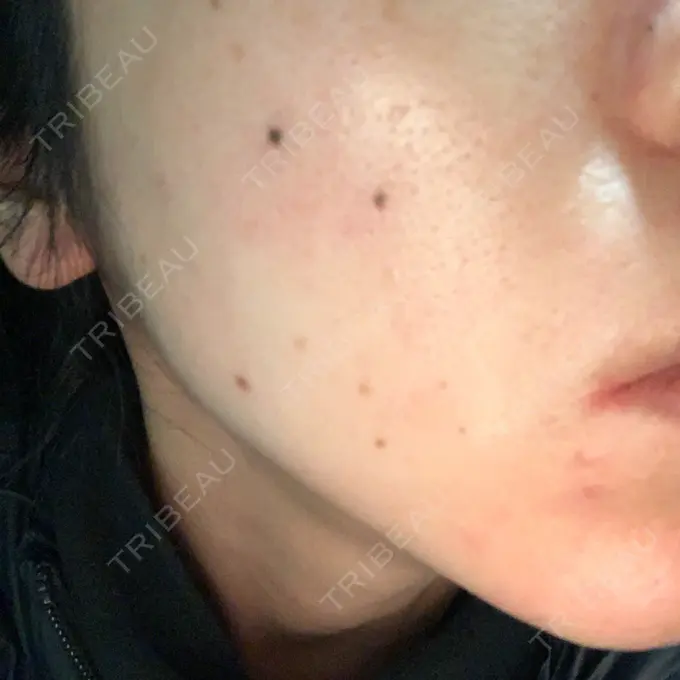 シミ取りレーザー Dual Clinic KOBE DAY 594 メイン用