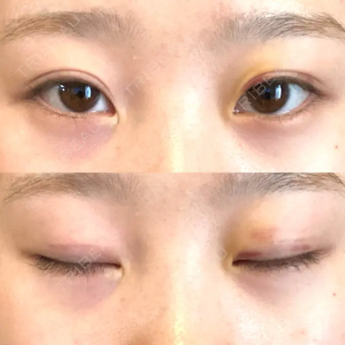 二重埋没 大西皮フ科形成外科医院 滋賀大津石山院 DAY 8 メイン用