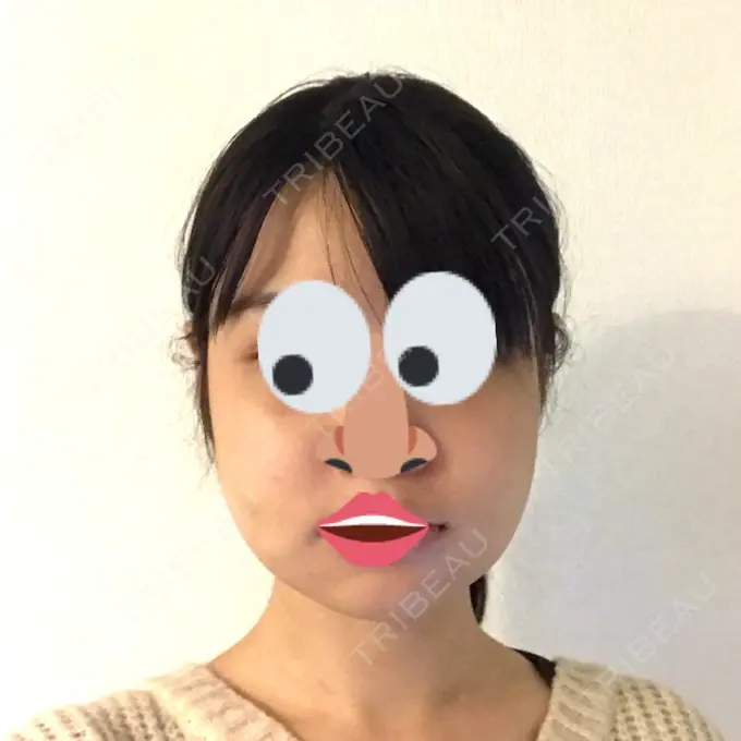 骨切り（あご） / 骨削り（エラ） / 骨削り（頬） よこはまエーブクリニック DAY 7 メイン用