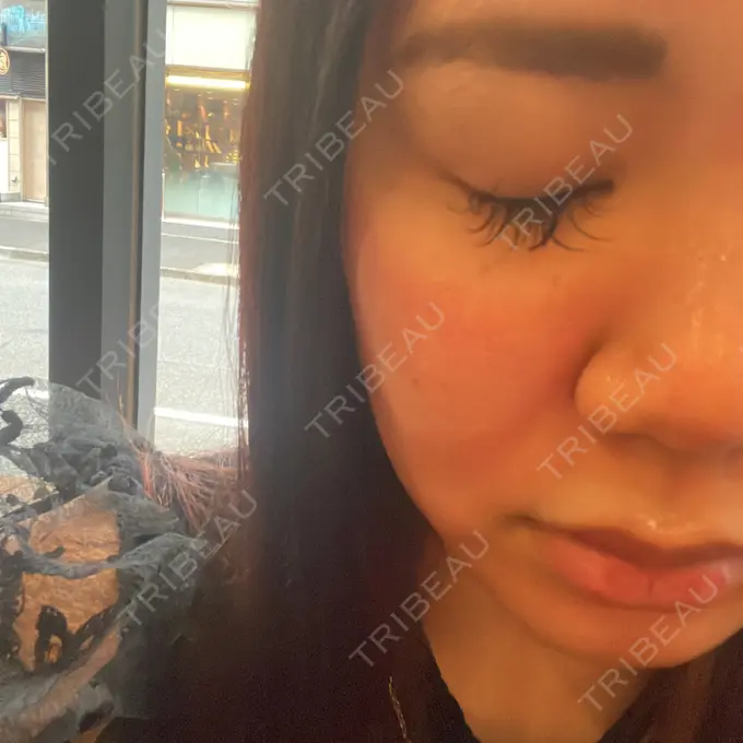 ヴェルヴェットスキン 銀座美容外科クリニック 銀座院 DAY 0 メイン用