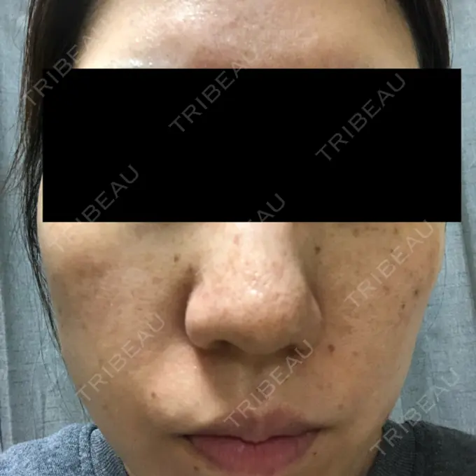 シミ取りレーザー フローラクリニック DAY 3 メイン用