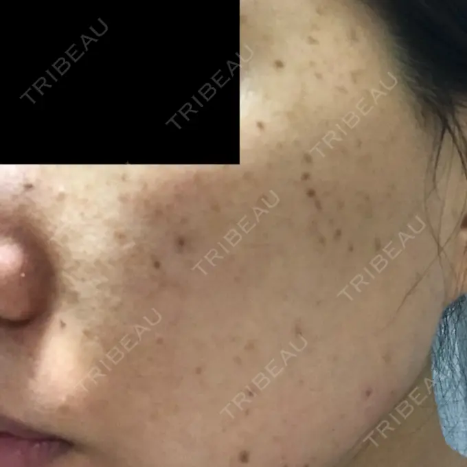 シミ取りレーザー フローラクリニック DAY 3 メイン用