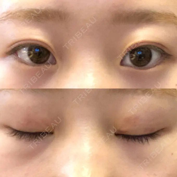 二重埋没 大西皮フ科形成外科医院 滋賀大津石山院 DAY 9 メイン用