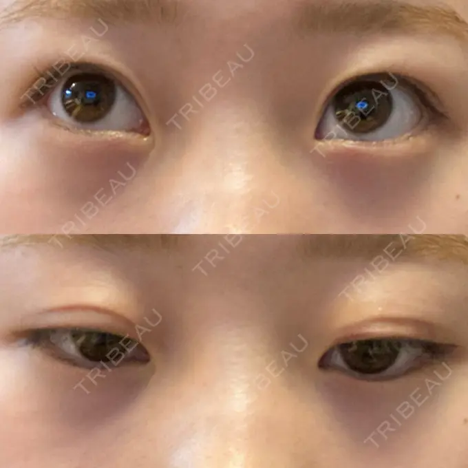 二重埋没 大西皮フ科形成外科医院 滋賀大津石山院 DAY 9 メイン用