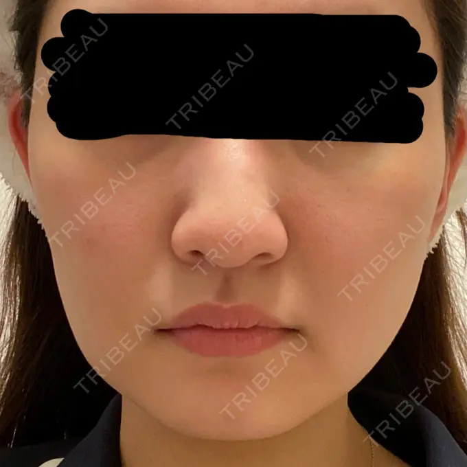 糸リフト / バッカルファット除去 / 脂肪吸引（顔） 東京ミッドクリニック DAY 15 メイン用