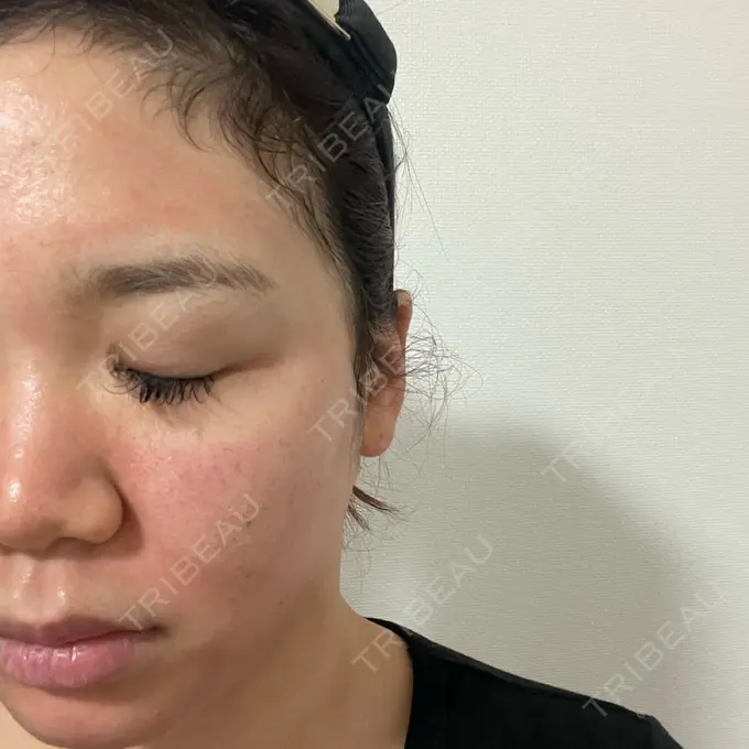 ヴェルヴェットスキン 銀座美容外科クリニック 銀座院 DAY 1 メイン用