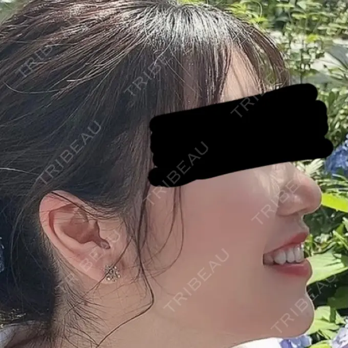 鼻尖形成（切開） / 軟骨移植 麹町皮ふ科・形成外科クリニック AFTER メイン用