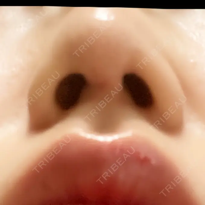 鼻尖形成（切開） / 軟骨移植 麹町皮ふ科・形成外科クリニック DAY 95 メイン用