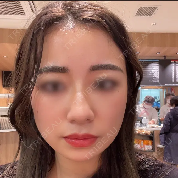 ハイフ（顔） STARS CLINIC AFTER メイン用