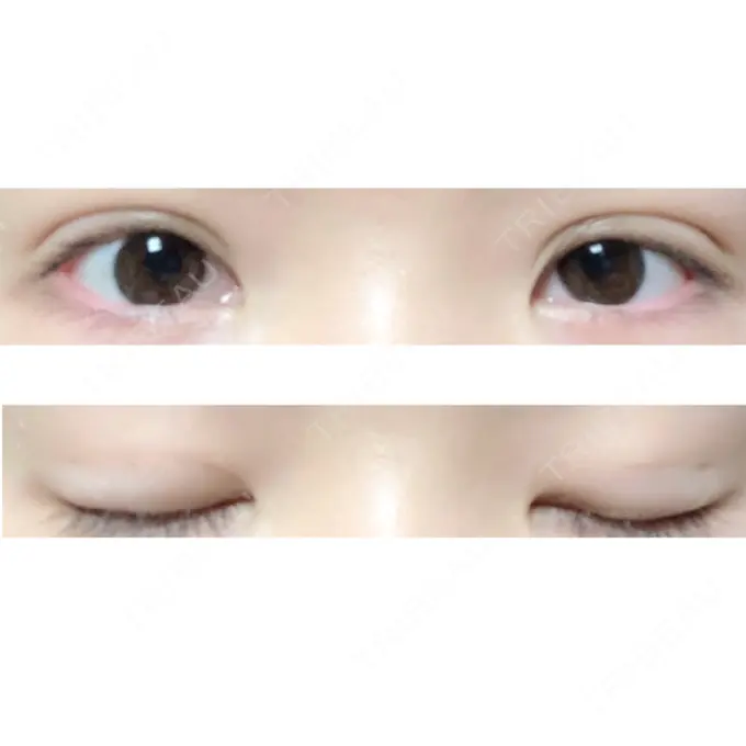 二重埋没 ハナビューティークリニック DAY 33 メイン用