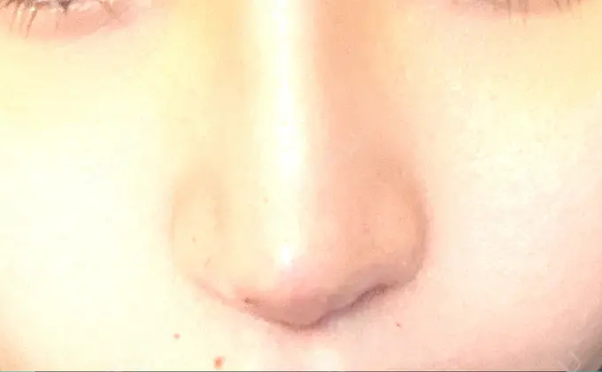 隆鼻術 / 鼻中隔延長（切開） / 鼻修正 / 鼻孔縁下降 / その他（鼻） みずほクリニック DAY 7 メイン用