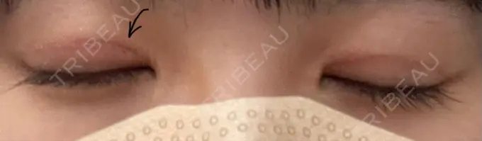 二重切開 こまちクリニック DAY 98 メイン用