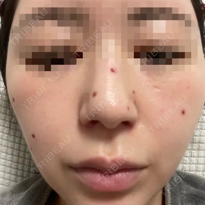 ほくろ・いぼ切除（肌） エースクリニック 大阪梅田HEPナビオ院 DAY 11 メイン用