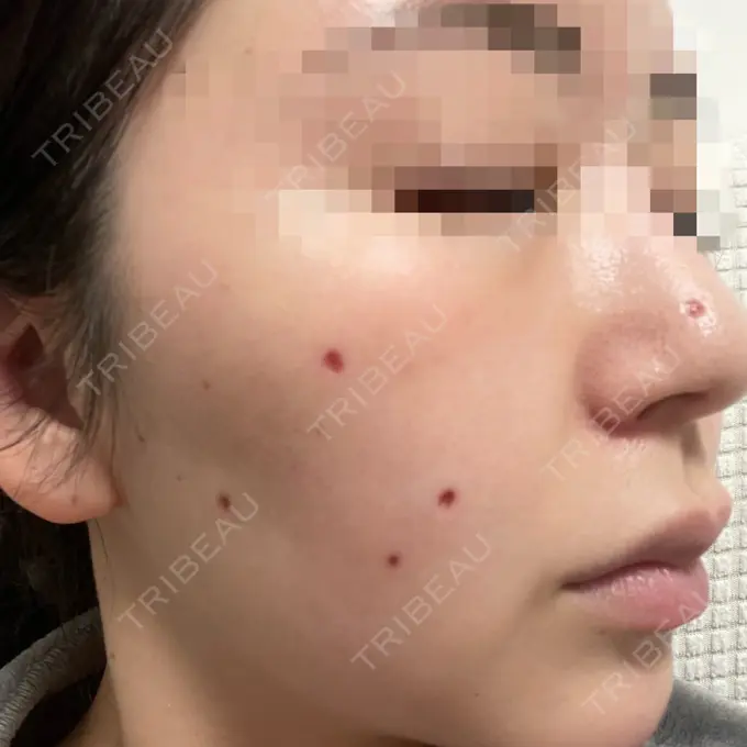 ほくろ・いぼ切除（肌） エースクリニック 大阪梅田HEPナビオ院 DAY 11 メイン用