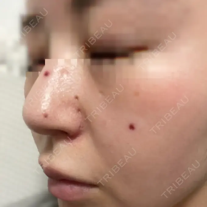 ほくろ・いぼ切除（肌） エースクリニック 大阪梅田HEPナビオ院 DAY 11 メイン用