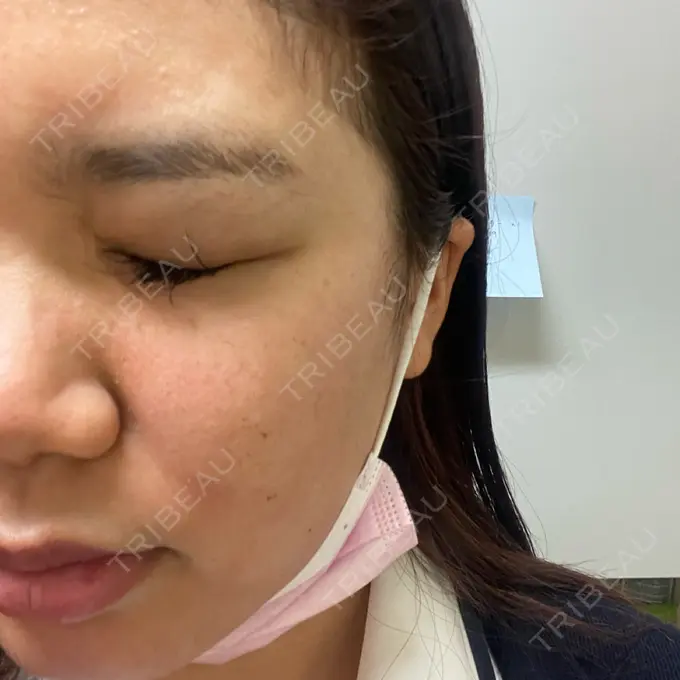 ヴェルヴェットスキン 銀座美容外科クリニック 銀座院 DAY 2 メイン用