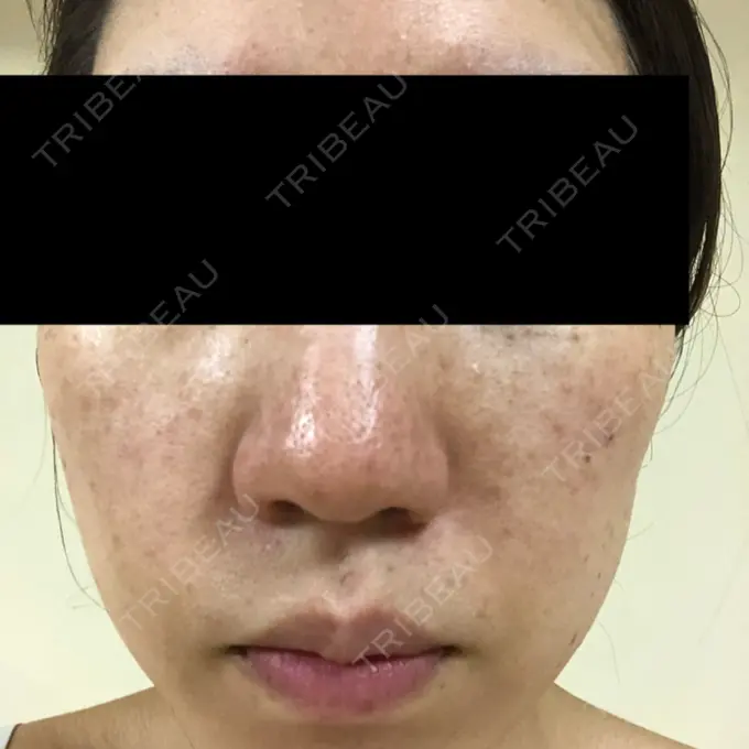 シミ取りレーザー フローラクリニック DAY 3 メイン用