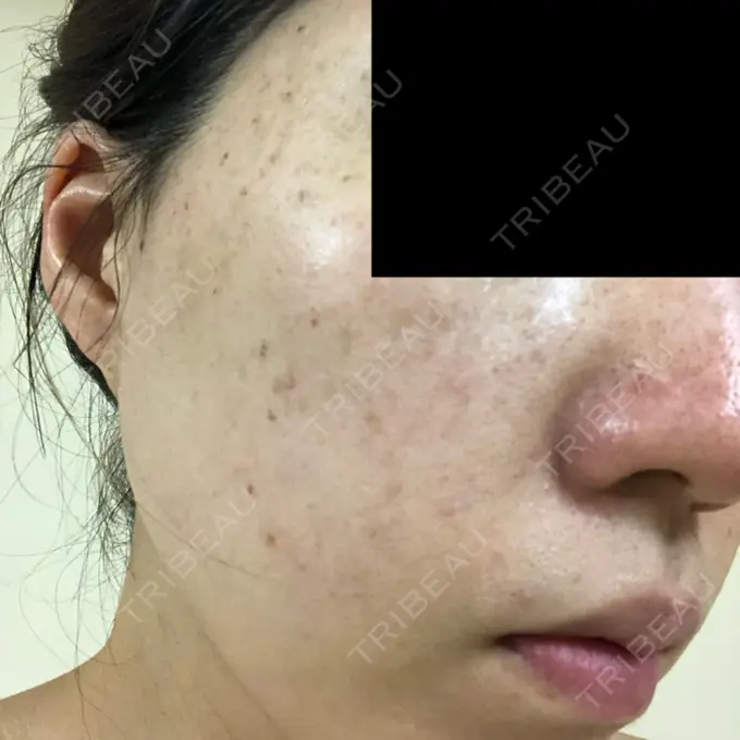 シミ取りレーザー フローラクリニック DAY 3 メイン用