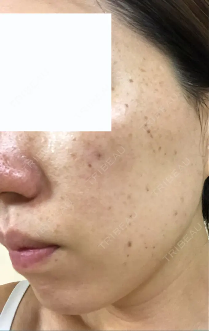 シミ取りレーザー フローラクリニック DAY 3 メイン用